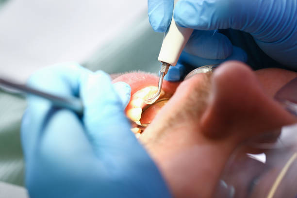 Best Emergency Dental Extractions in Flagtown, NJ